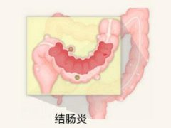 南寧治療結腸炎哪家醫院